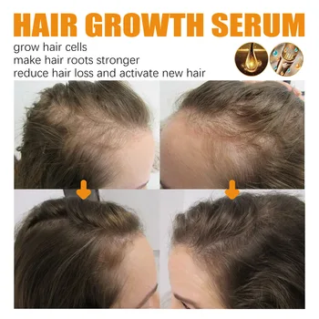 Rychlý Růst Vlasů Produkty Silný Anti-Vypadávání Vlasů Opravit Poškozené Vlasy Ztráta Léčba, Klimatizace Olej Tekuté Sérum Pro Ženy 2